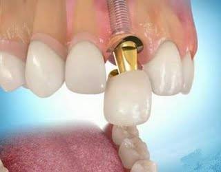 Implantes de última tecnología en Valencia