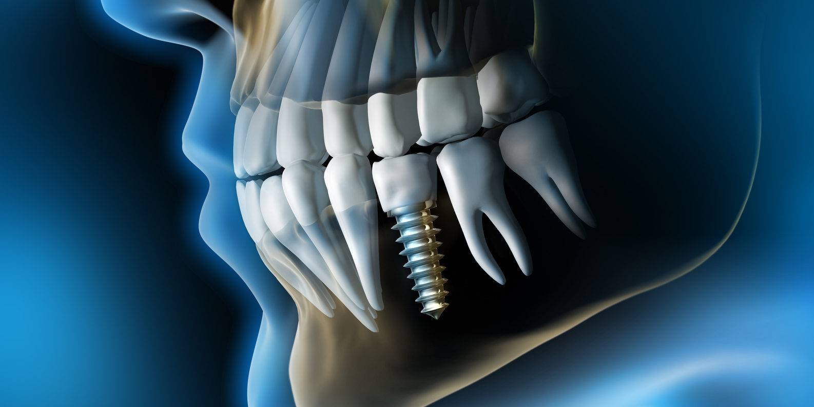 Implantes dentales Valencia