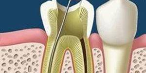 Endodoncias dentales