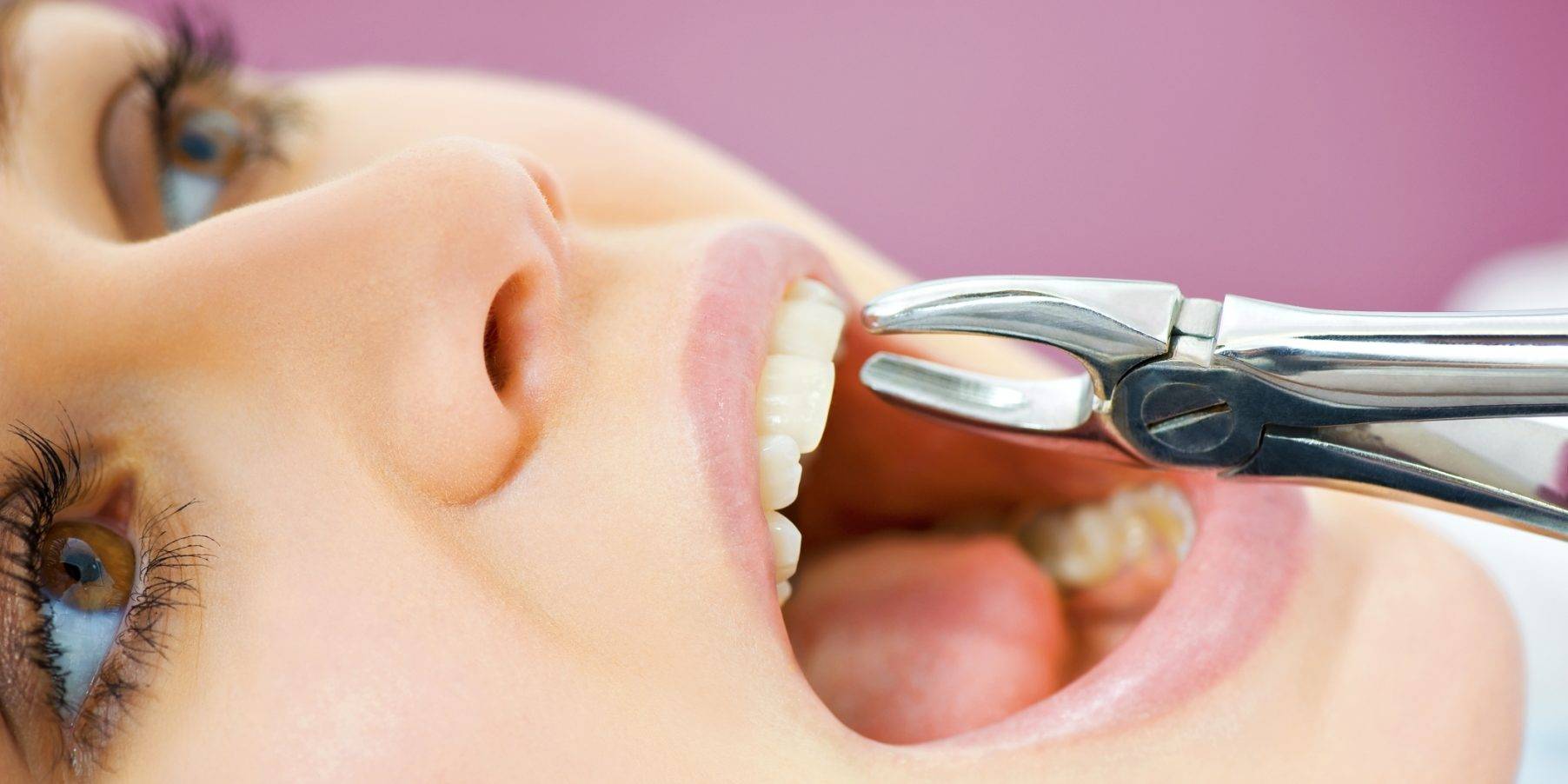 Extracciones dentales