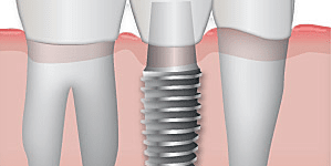 Implantología dental