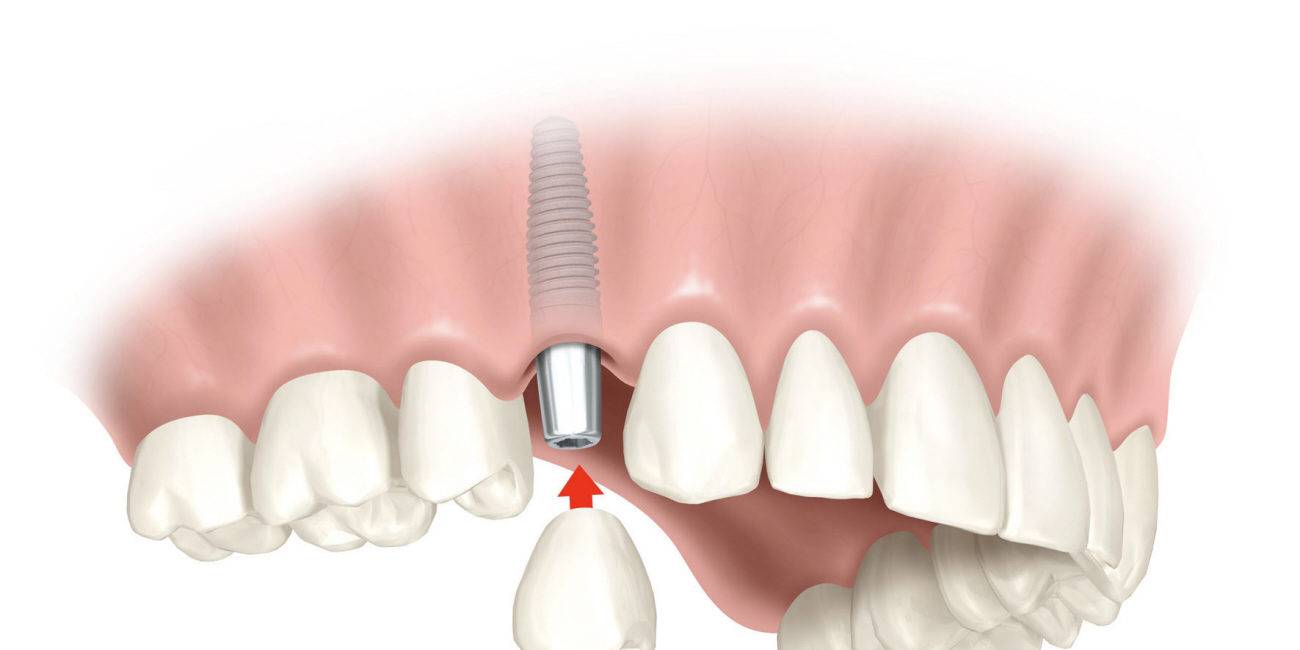 Oferta en implantes dentales