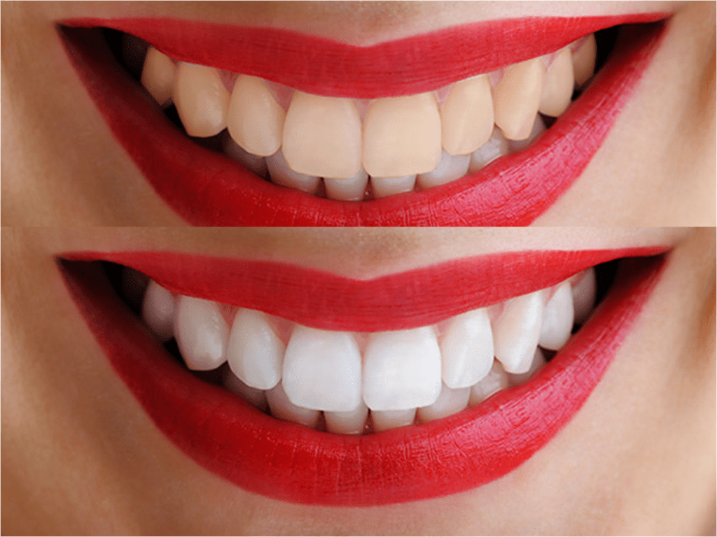 Tratamiento de blanqueamiento dental en Valencia Clínica Dental Almar Tratamiento de blanqueamiento dental en Valencia Clínica Dental Almar