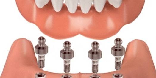 Implantología dental de calidad