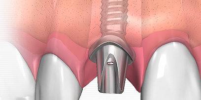 Oferta de implantes en Valencia