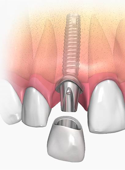 Oferta de implantes en Valencia