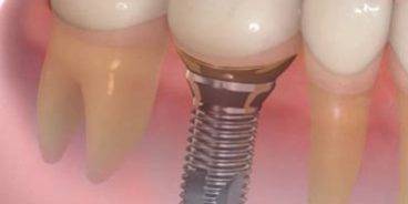 Implantes dentales Valencia