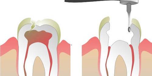 Endodoncias dentales Valencia
