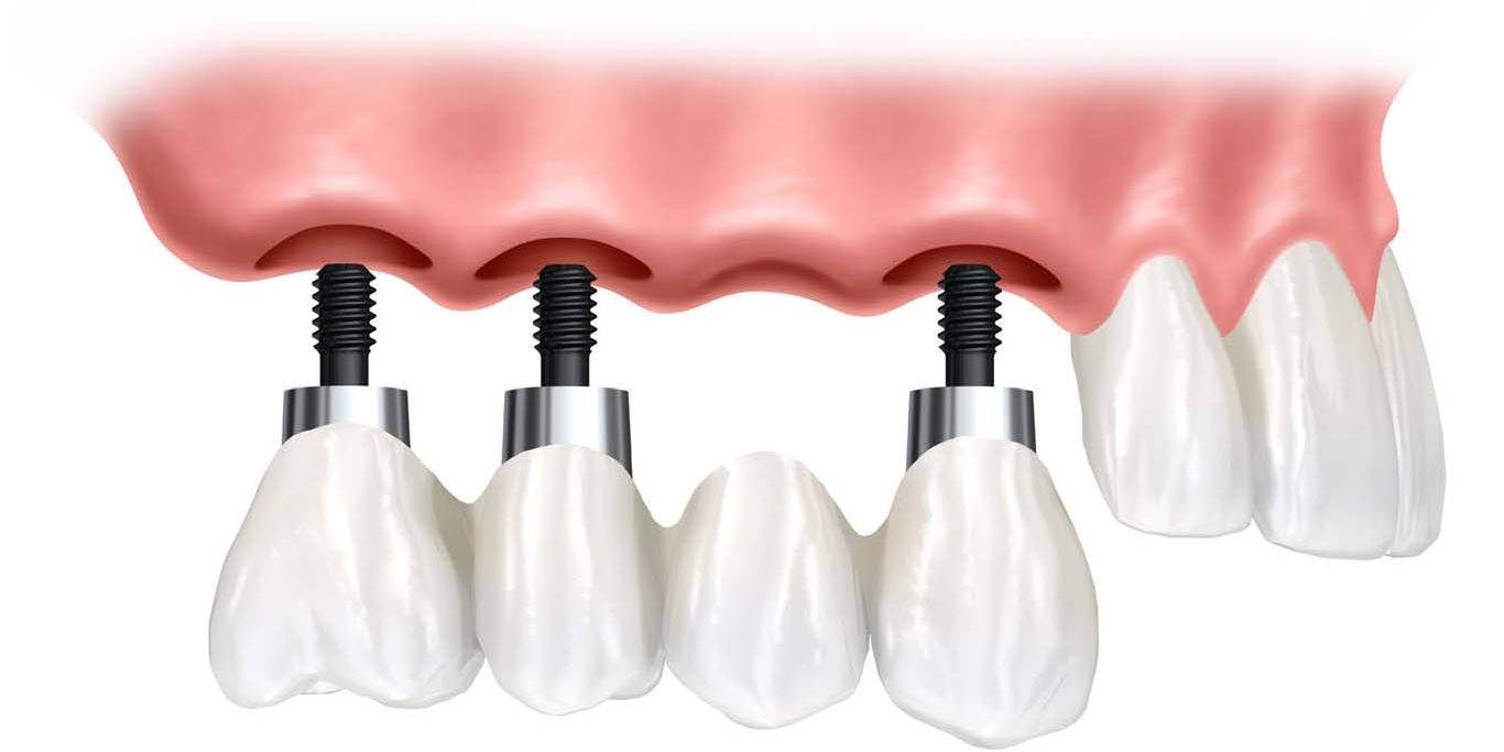 Profesionales en implantes dentales Valencia