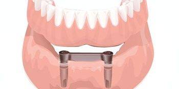 Precio para implantes dentales Valencia