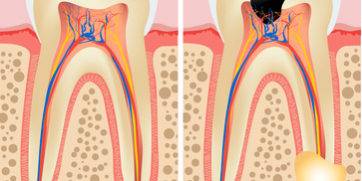 Endodoncias dentales Valencia
