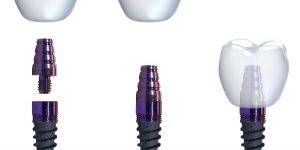 Servicios de implantología dental Valencia