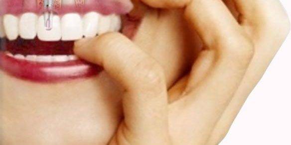 Implantes en Valencia