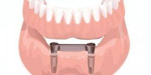 Presupuesto implantes dentales Valencia