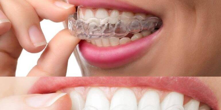 Presupuesto ortodoncia Valencia – Imagen de ortodoncia invisible