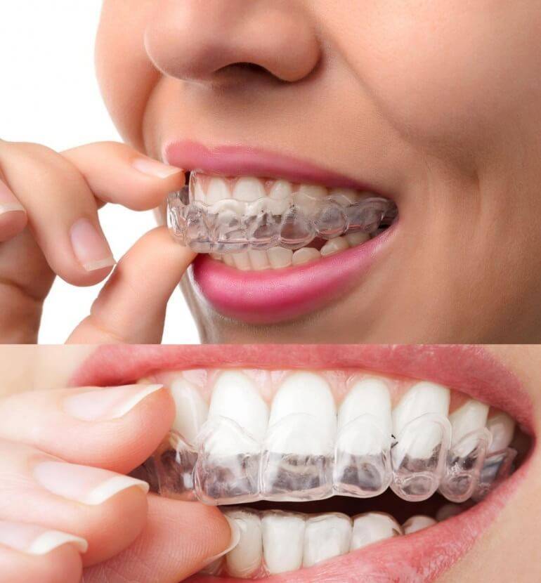 Presupuesto ortodoncia Valencia – Imagen de ortodoncia invisible