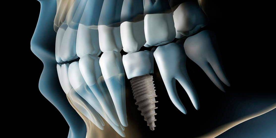 Valoración implantología gratuita Valencia – Radiografía de implantes dentales