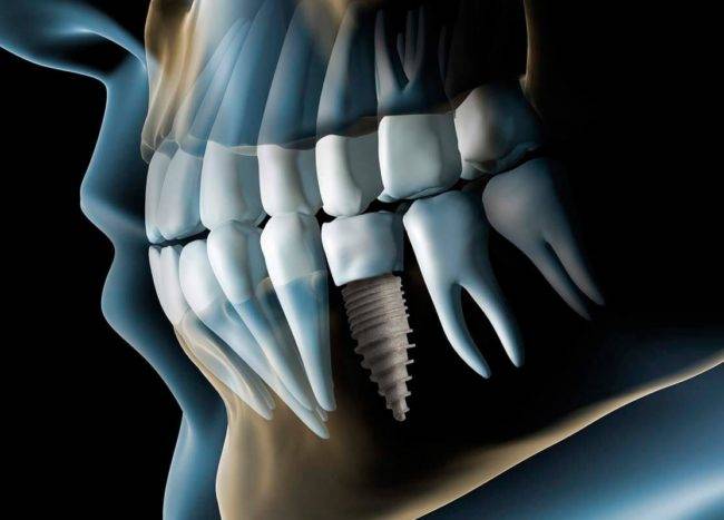 Valoración implantología gratuita Valencia – Radiografía de implantes dentales