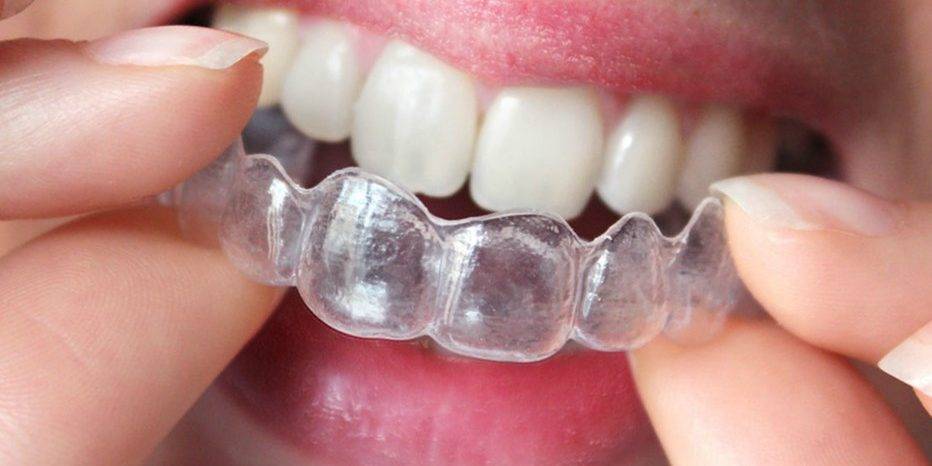 Ortodoncia invisible Valencia – Clínica dental con experiencia