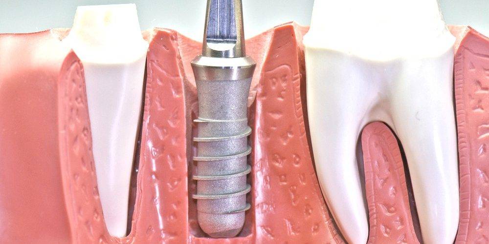 Implantes Valencia profesionales – Clínica dental profesional