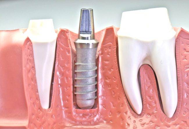 Implantes Valencia profesionales – Clínica dental profesional