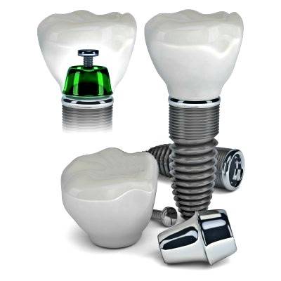 Implantología dental Valencia – Clínica Dental Almar