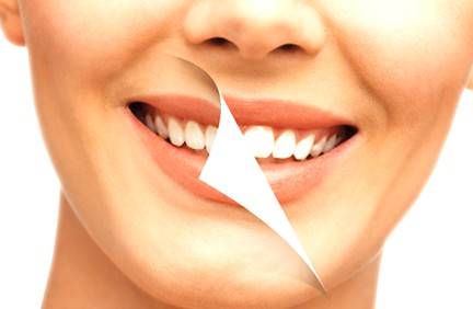 Blanqueamiento dental Valencia – Tratamientos de alta calidad