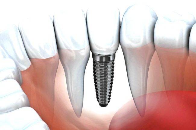 Implantes dentales Valencia – Clínica con años de experiencia