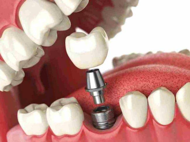 Implantología dental Valencia – Tratamientos de alta calidad