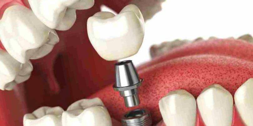 Implantología dental Valencia – Tratamientos de alta calidad