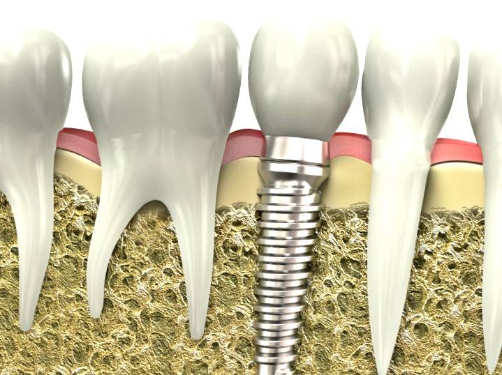 Implantes dentales Valencia – Clínica de implantología dental
