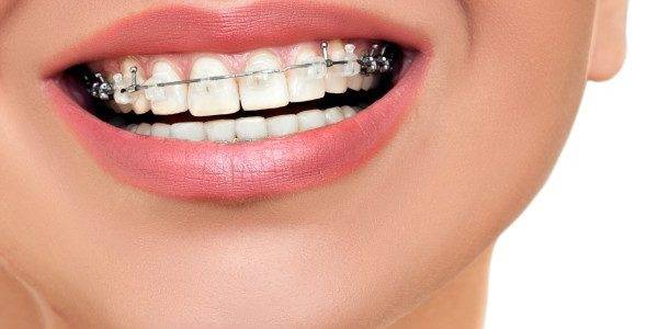Precio ortodoncia Valencia – Clínica con años de experiencia