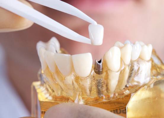 Profesionales en implantes Valencia – Profesionales y con experiencia