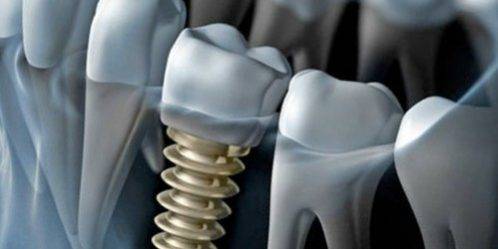 Implantes dentales Valencia – Clínica Dental Almar