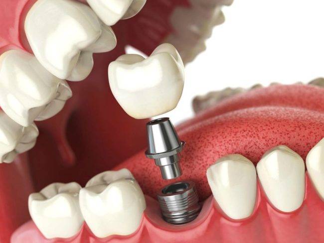 Presupuesto implantes dentales Valencia – Implantología dental en Valencia