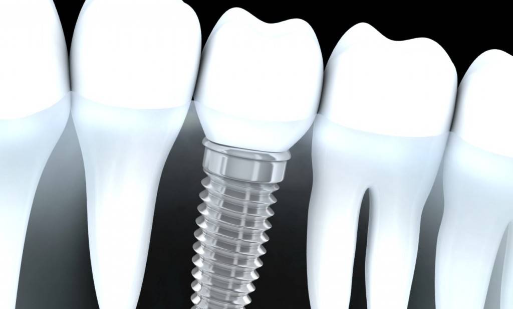 Implantes Valencia - Clínica dental en Valencia