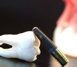 Implantes Valencia - Implantología dental profesional