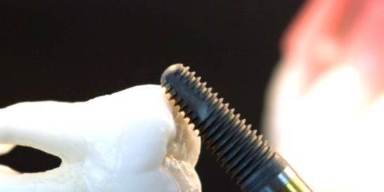 Implantes Valencia – Implantología dental profesional