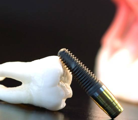 Implantes Valencia – Implantología dental profesional