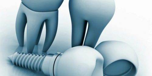 Implantología dental Valencia – Clínica con años de experiencia