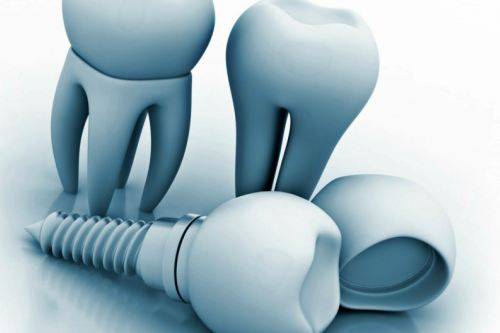 Implantología dental Valencia – Clínica con años de experiencia