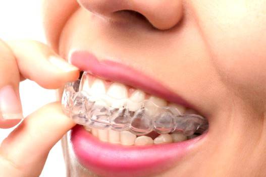 Ortodoncia invisible Valencia – Tratamientos de alta calidad