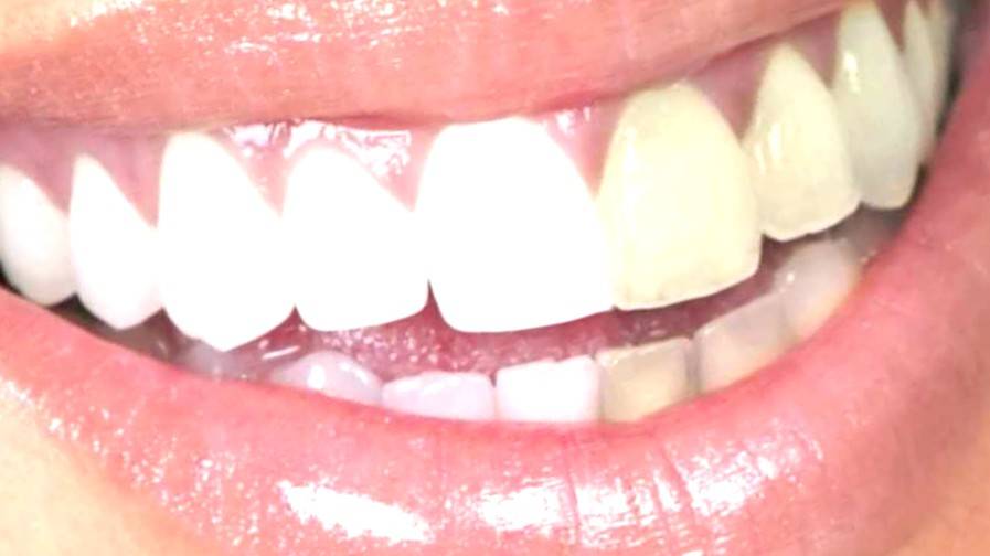 Blanqueamiento dental Valencia - Clínica con años de experiencia
