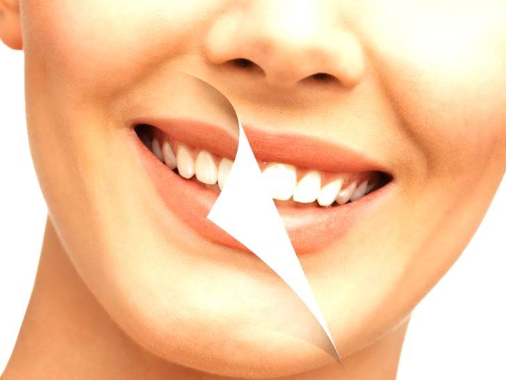Blanqueamiento dental Valencia – Tratamiento de blanqueamiento dental