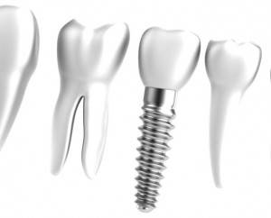 Implantes dentales Valencia - Clínica de implantología dental en Valencia