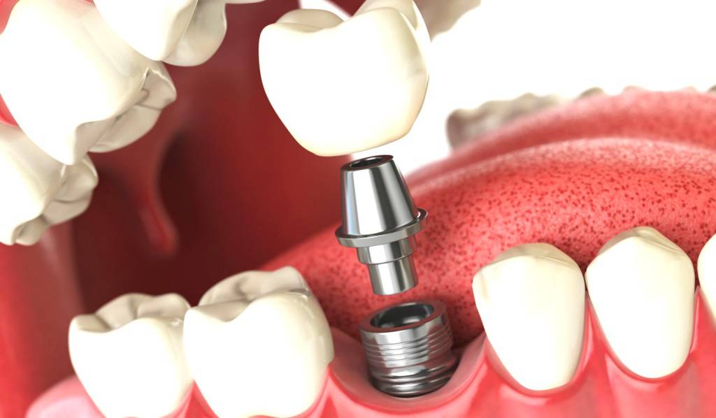 Implantes dentales Valencia - Implantes de calidad en Valencia
