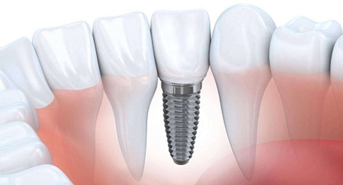 Implantes y dientes en el día