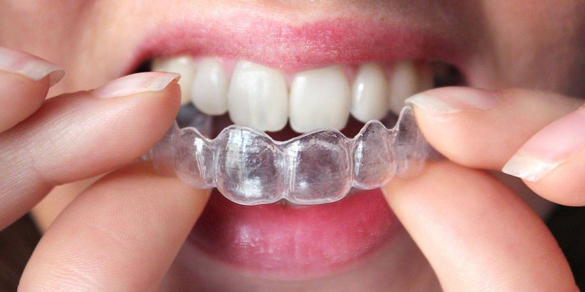 Clínica con tratamiento de ortodoncia invisible Valencia Clínica con tratamiento de ortodoncia invisible Valencia