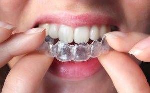 Clínica con tratamiento de ortodoncia invisible Valencia