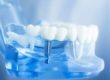 Clínica de implantes dentales Valencia